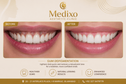 before and after Gum Depigmentation in Islamabad