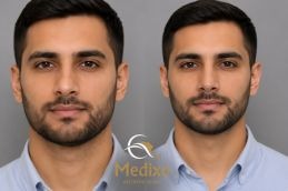 before and after Rhinoplasty in Islamabad
