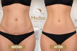 before and after Tummy tunk islamabad