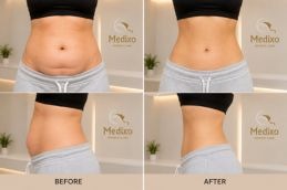 before and after picture of tummy tunk