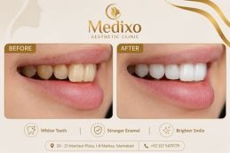 results before and after of Teeth Polishing and Scaling In Islamabad