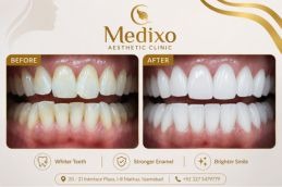 Results of Teeth Polishing and Scaling In Islamabad