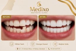 Treatment of Teeth Polishing and Scaling In Islamabad