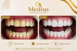 before and after Teeth Polishing and Scaling In Islamabad