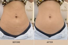 before and after tummmy tunk islamabad and rawalpindi
