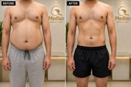 results of Liposuction in Islamabad